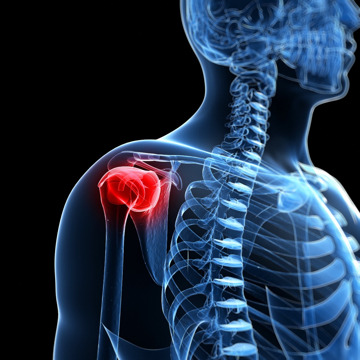 Rotator Cuff Tears Orthopedic Centers of Colorado